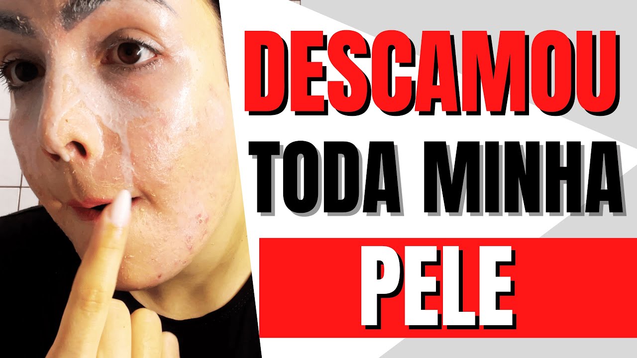 PEELING QUÍMICO: QUAL SKINCARE CORRETA ANTES e DEPOIS para MANCHAS DE ACNE?