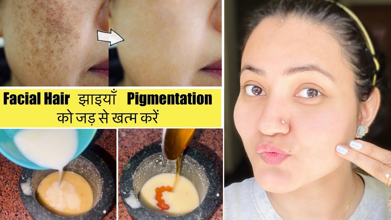 In 7 Days 💕Remove झाइयाँ, Blemishes, Pigmentation, Facial Naturally & Get Clear Glowing Skin
