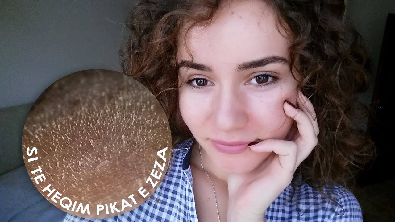 Si te heqim pikat e zeza ne kushte shtepie (Maska me xhelatine) [Albanian]