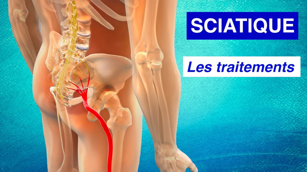 SOULAGER LA SCIATIQUE : Les traitements