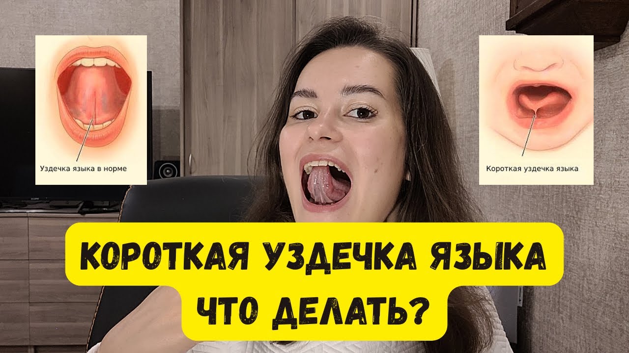 КОРОТКАЯ УЗДЕЧКА ЯЗЫКА. Чем она опасна и что делать?