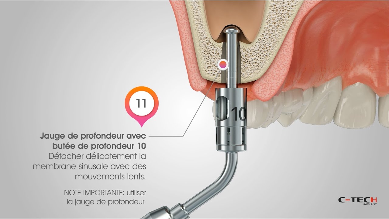 Crestal Sinus Lift - FRA