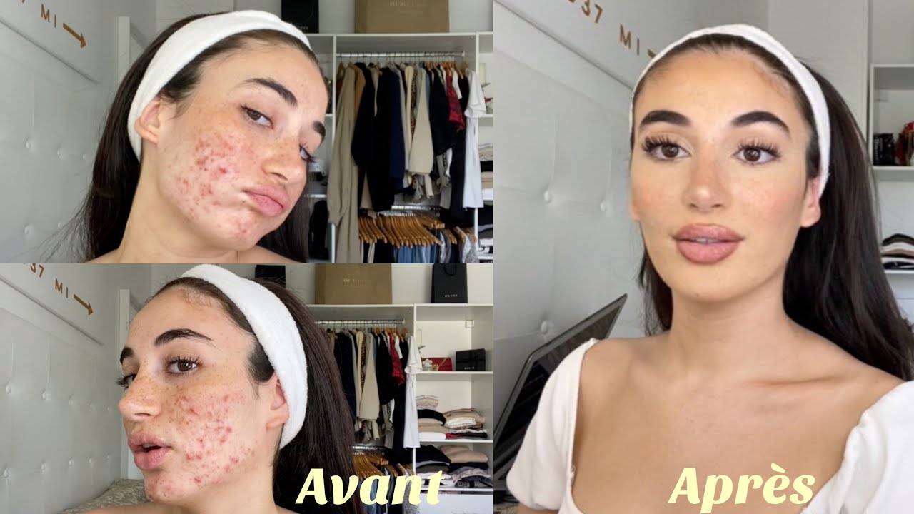MAQUILLAGE COMMENT CAMOUFL&Eacute; SON ACN&Eacute; (myrcrokystes, boutons jaunes et t&acirc;ches)