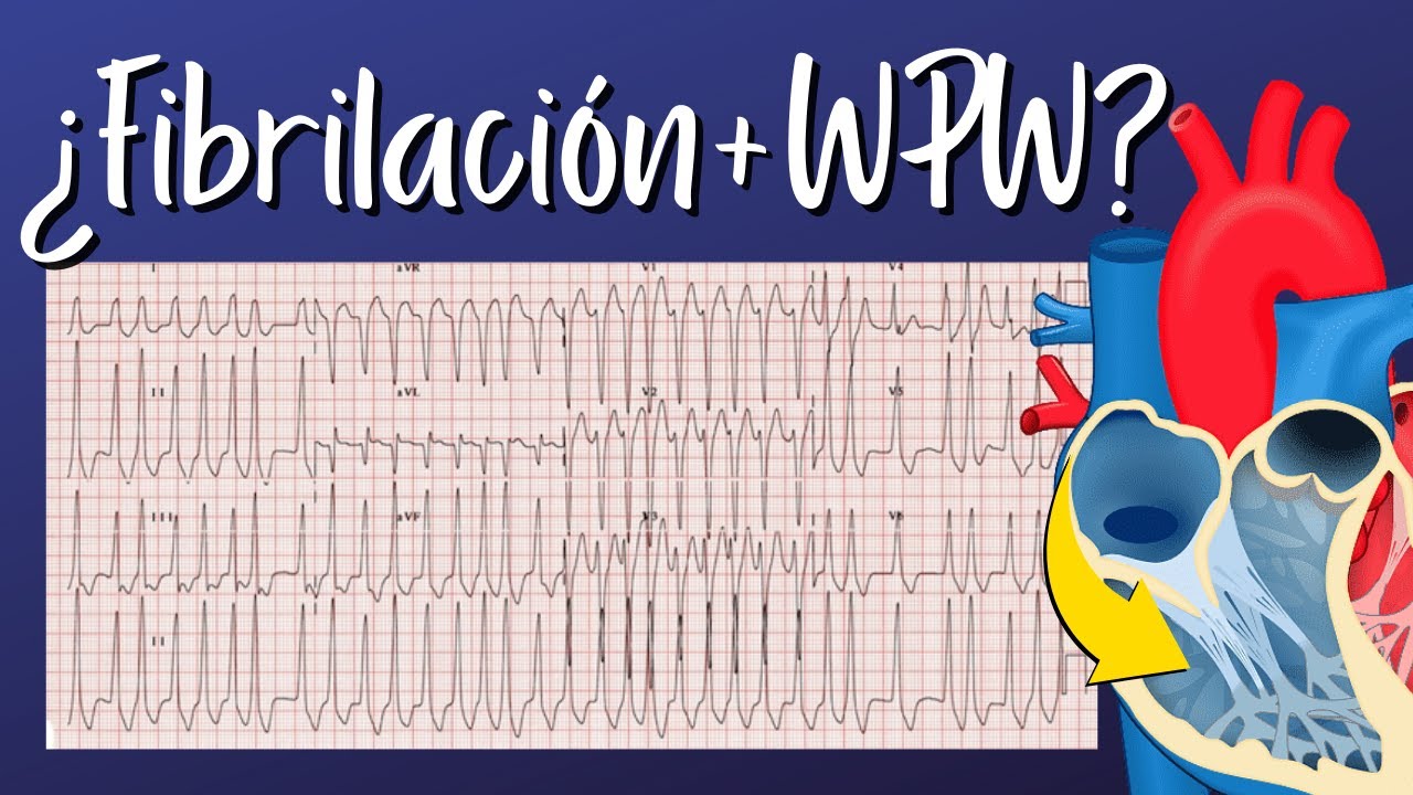 El Paciente con Fibrilación Auricular y Wolff Parkinson White