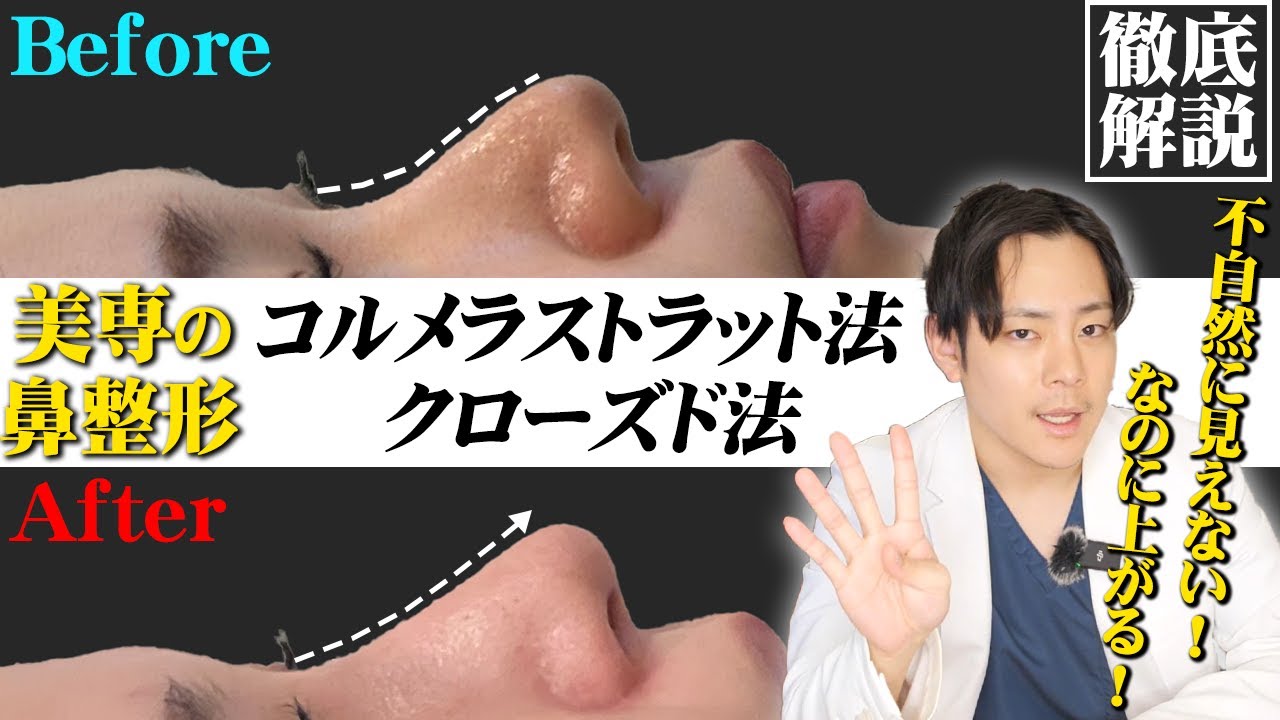 コルメラストラット法のメリットとデメリットを徹底解説してみます