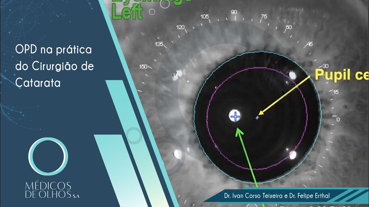 Videoaula OPD-Scan III: na prática do Cirurgião de Catarata