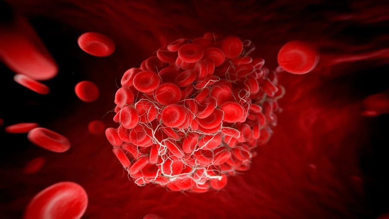 Síndrome antifosfolipídico: Diagnóstico y manejo durante el embarazo -  Dr. Rocnel Amundaray