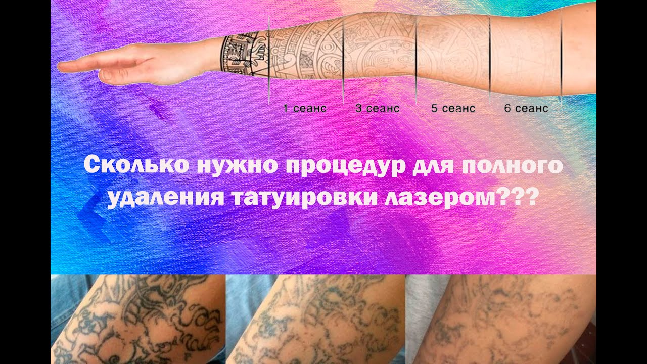 Удаление татуировки лазером. Сколько нужно процедур?..