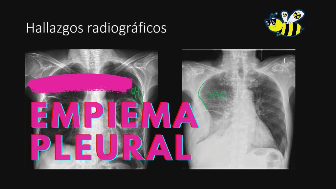 Empiema Pleural