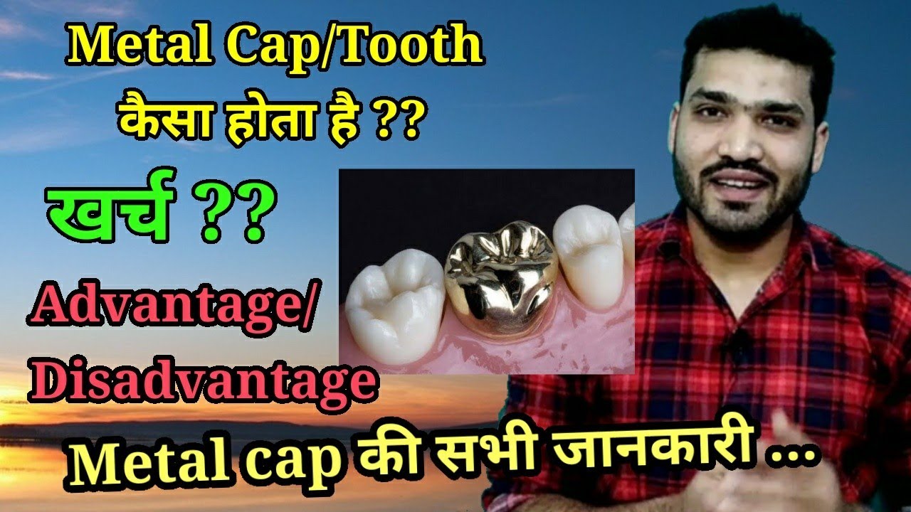 Metal tooth cap ? Cost, strength , durability? मेटल के दाँत या कैप कैसे होते है ? एक दाँत का खर्च?