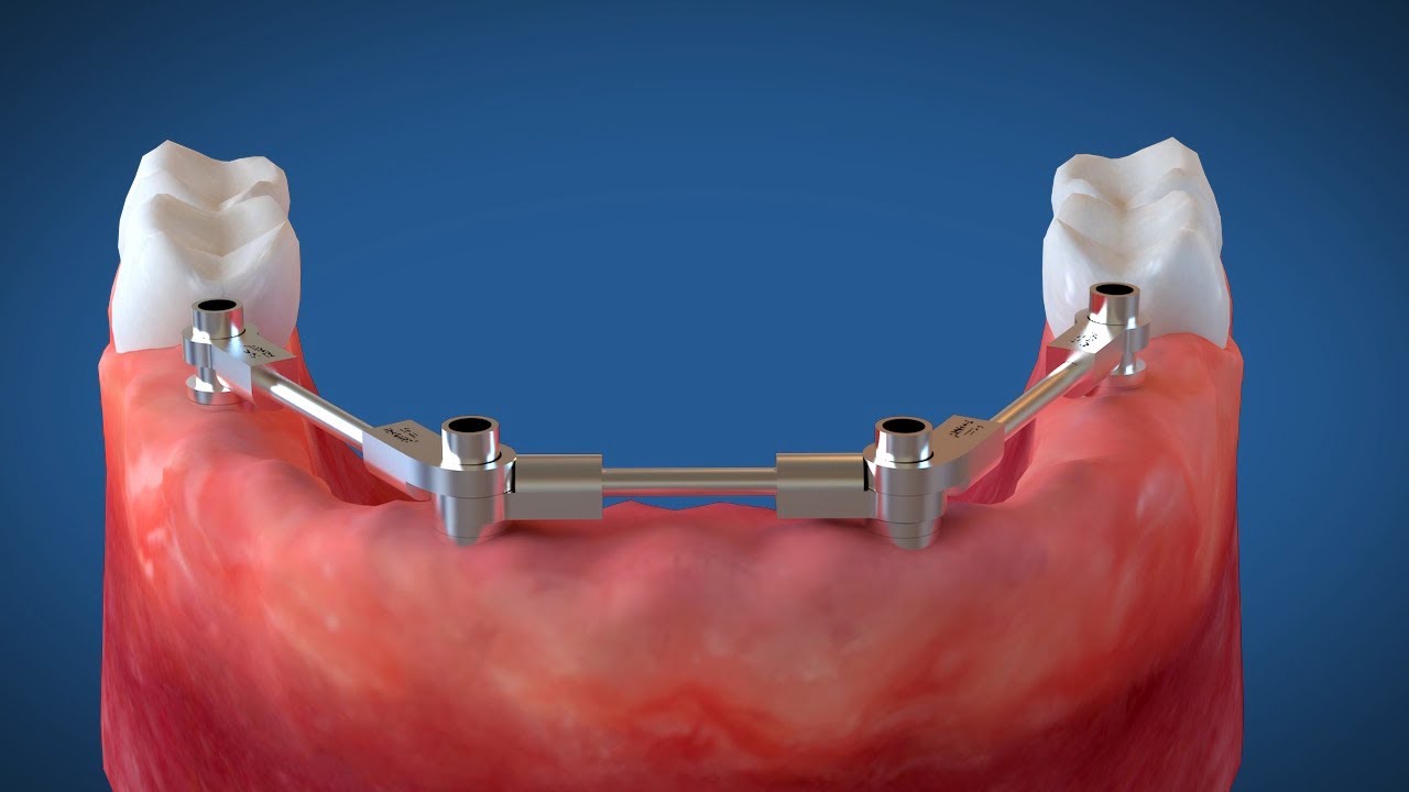 Video Animazione 3D Implantologia dentale a carico immediato (Intervento Chirurgico)
