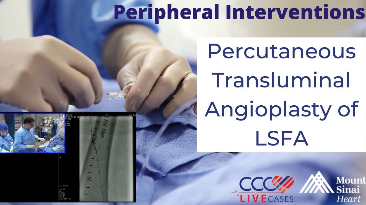 Percutaneous Transluminal Angioplasty of LSFA - Peripheral Interventions June 22, 2016