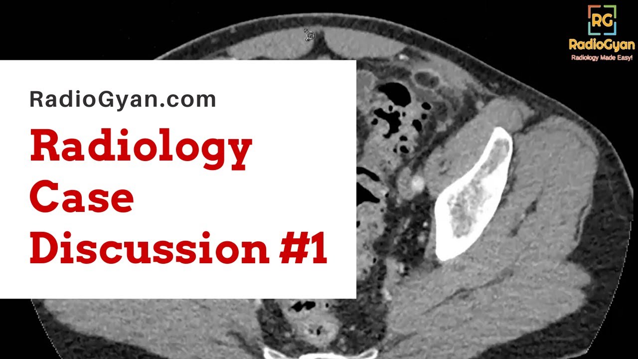 Acute Epiploic Appendagitis | Radiology Board Review Case