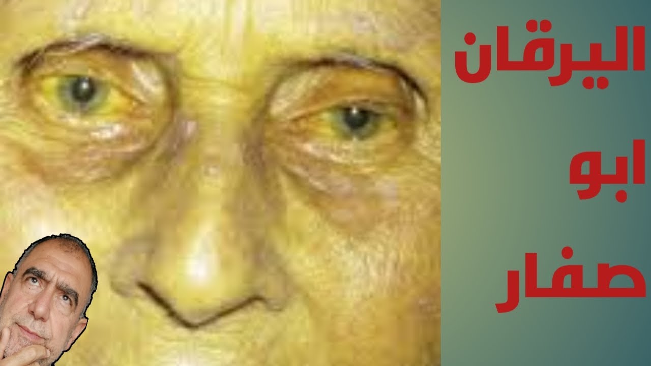 اليرقان ـأبو صفارـ الاسباب والتشخيص