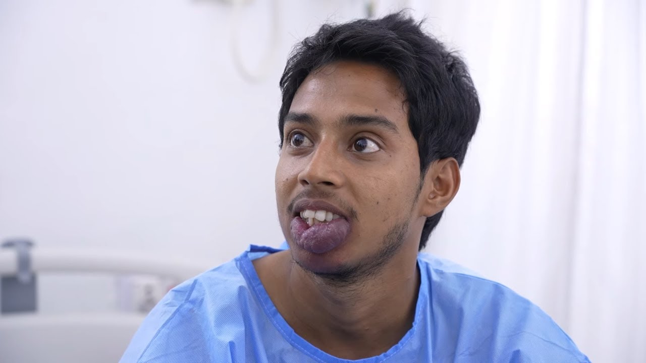 Large Hemangioma removal from his lips - Before & After