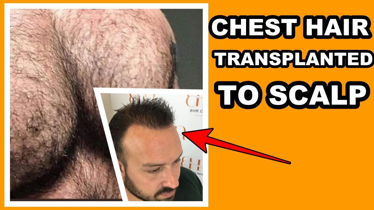 FUE SURGERY BODY HAIR TO SCALP | What Happened With His Chest Hair? 