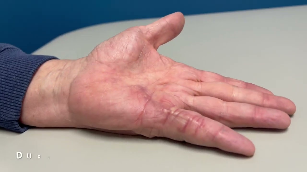 Dupuytren's Contracture Before and After Surgery
