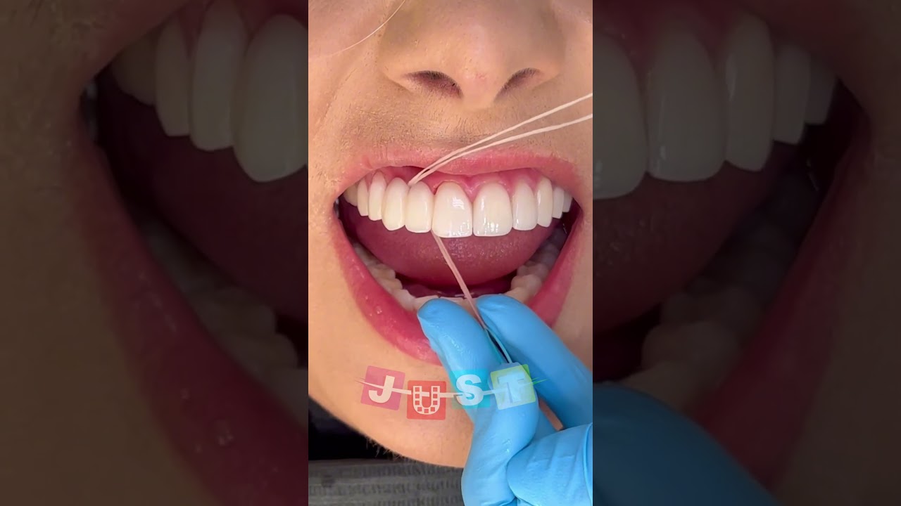 Nitkowanie zęb&oacute;w za pomocą mostu dentystycznego 🦷 #stomatologia