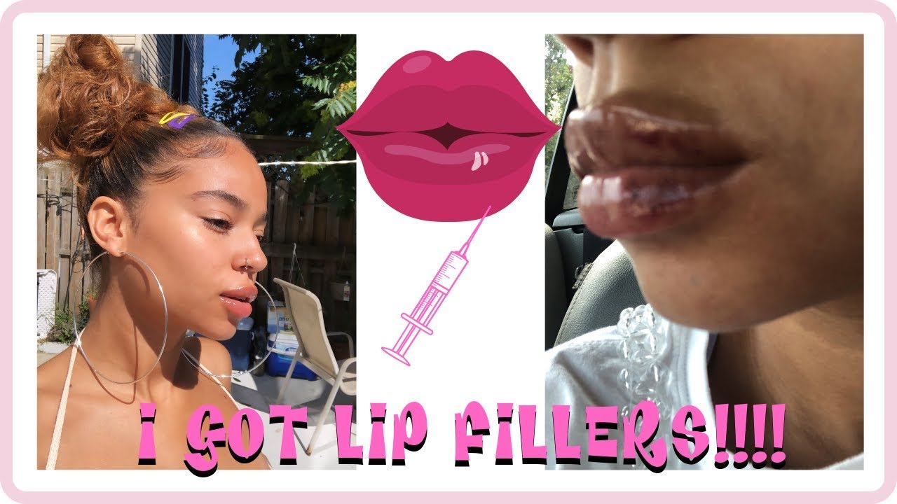 I GOT LIP FILLERS!!!! Beauty Fix Med Spa NYC
