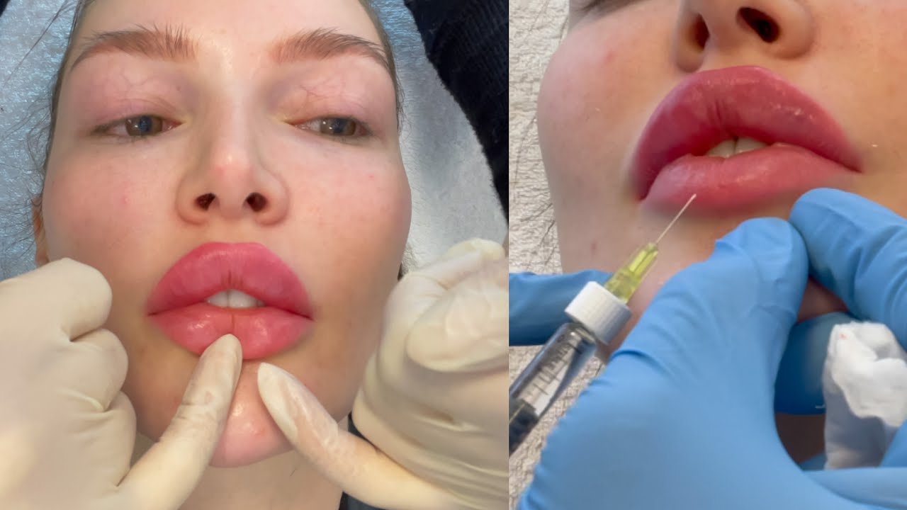 Ich will mehr.. 💉 Lippen aufspritzen russische Technik & Abheilungs Tagebuch - VLOG