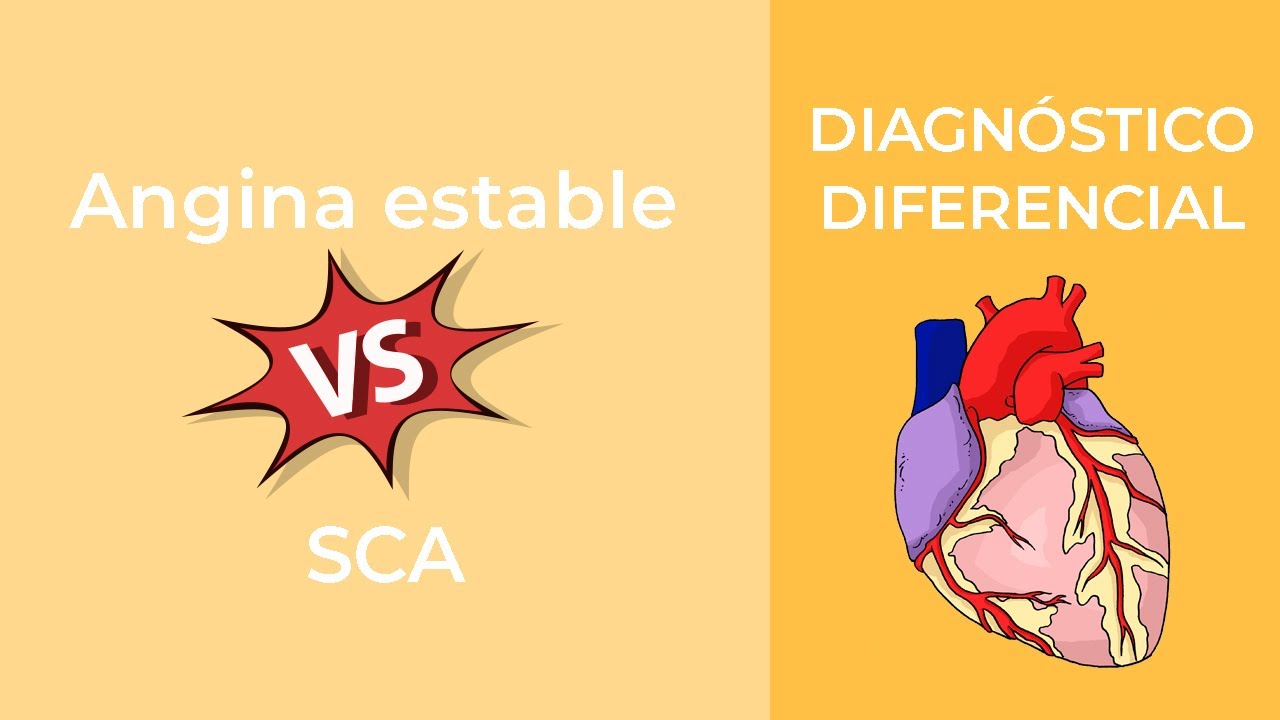 Diagnóstico Diferencial Angina estable vs SCA