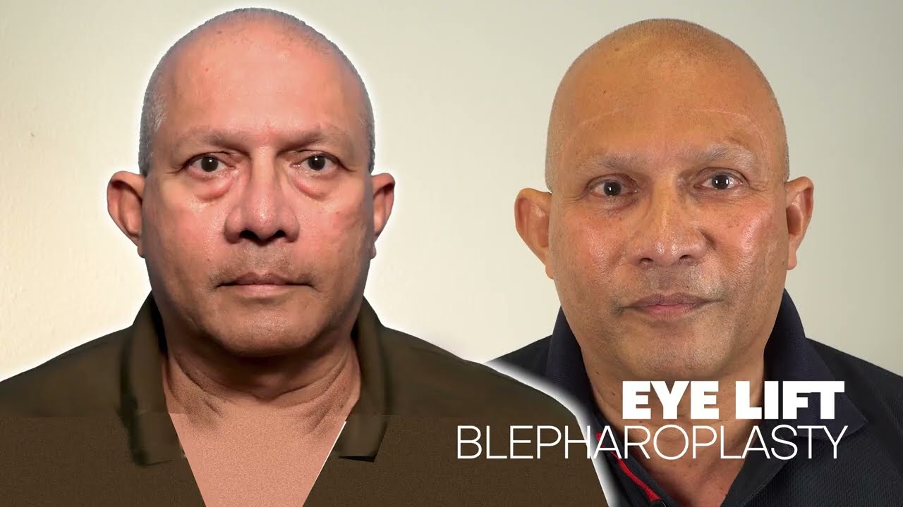 Dr. Mobley  Eyelid lift _ Keith's experience