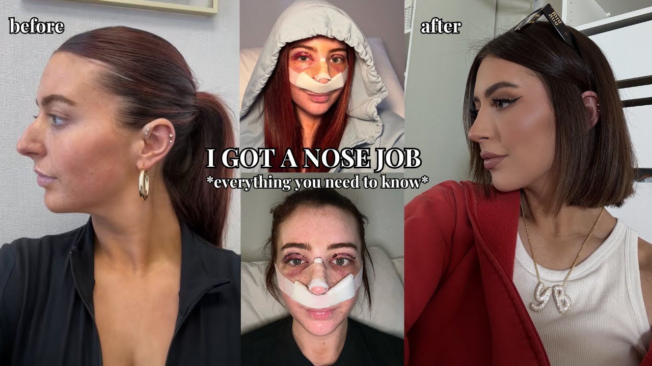 nose job
