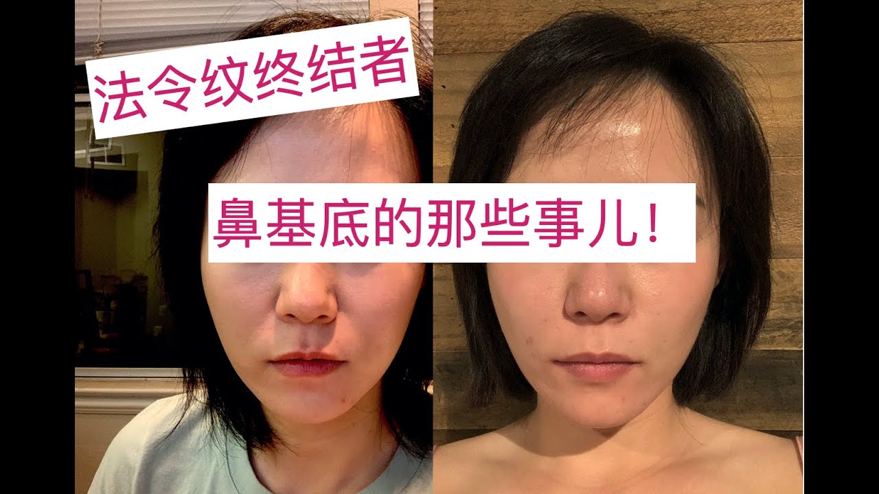 法令纹深？可能是鼻基底凹陷！填充瞬间年轻5岁
