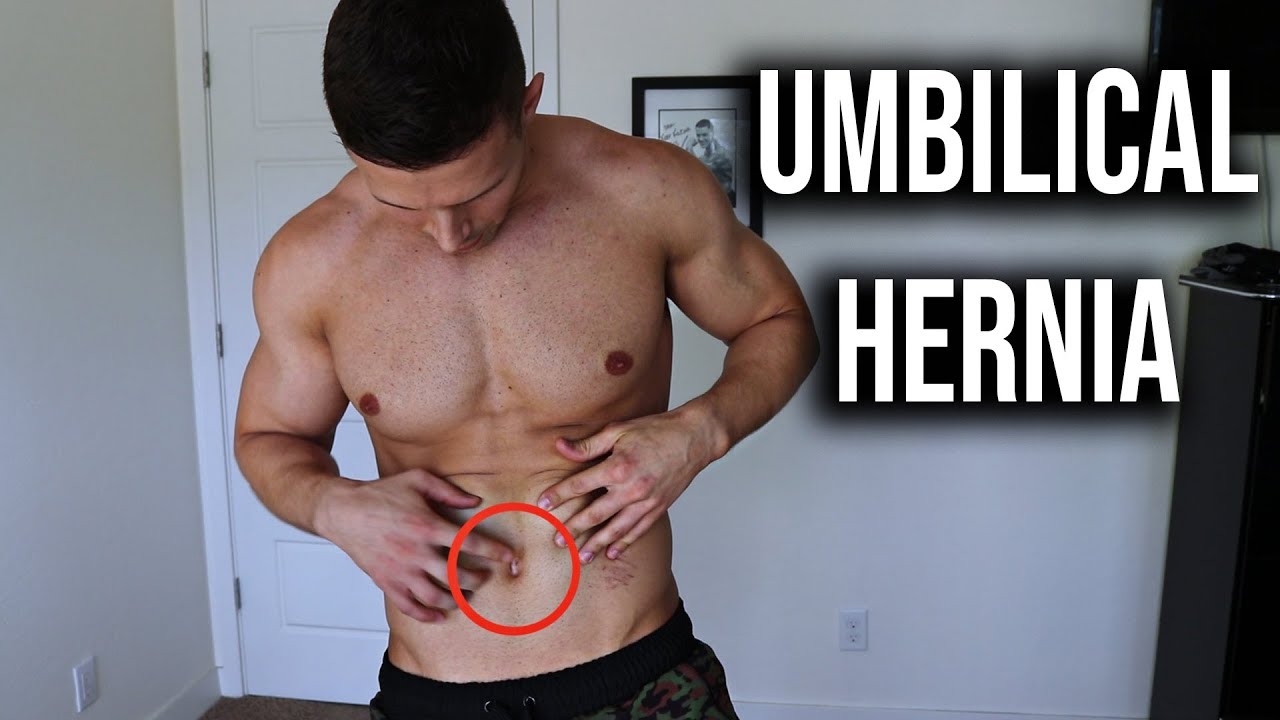 Umbilical Hernia