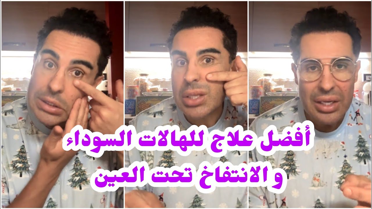 علاج الهالات السوداء و الانتفاخ تحت العين 👍+ مواضيع اخرى مع دوك صمد ❤️