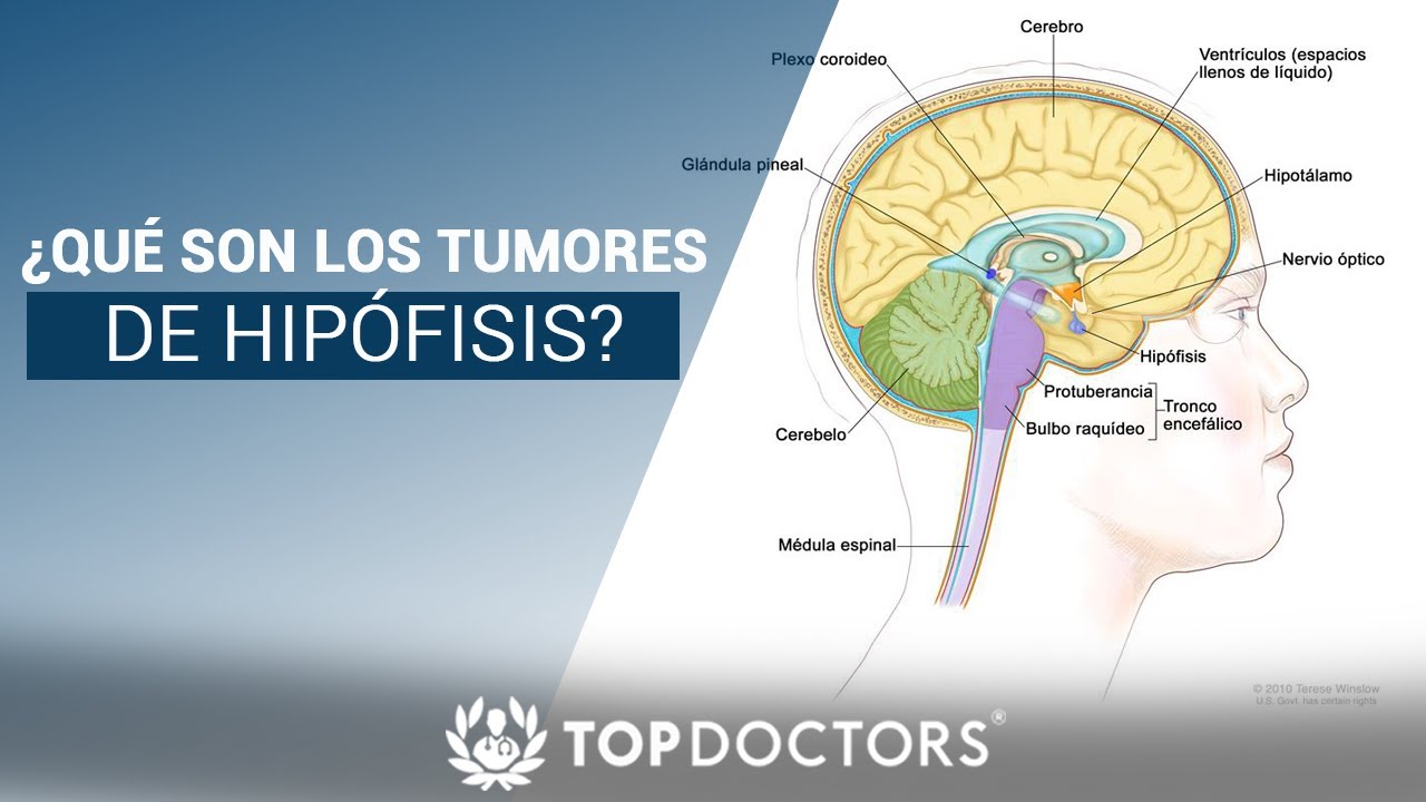 ¿Qué son los tumores de hipófisis y cómo se desarrollan?