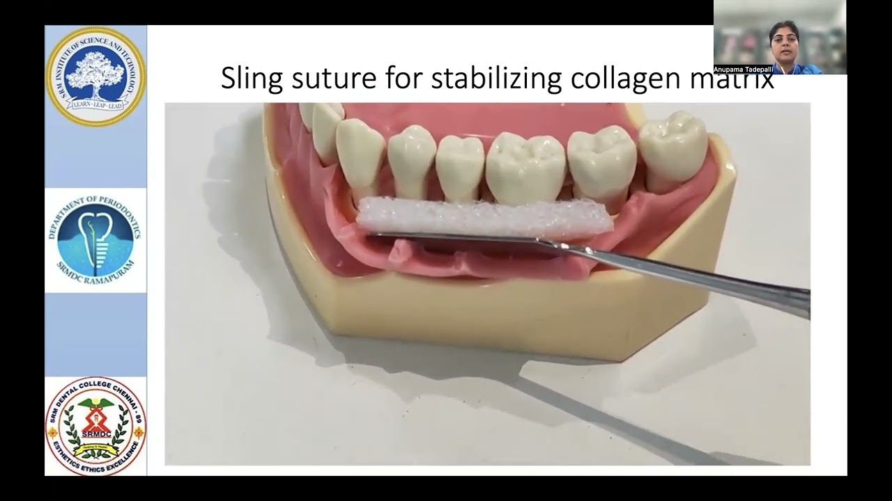 Sling Suture - Dr.Anupama Tadepalli professor - Dept.of.Periodontology