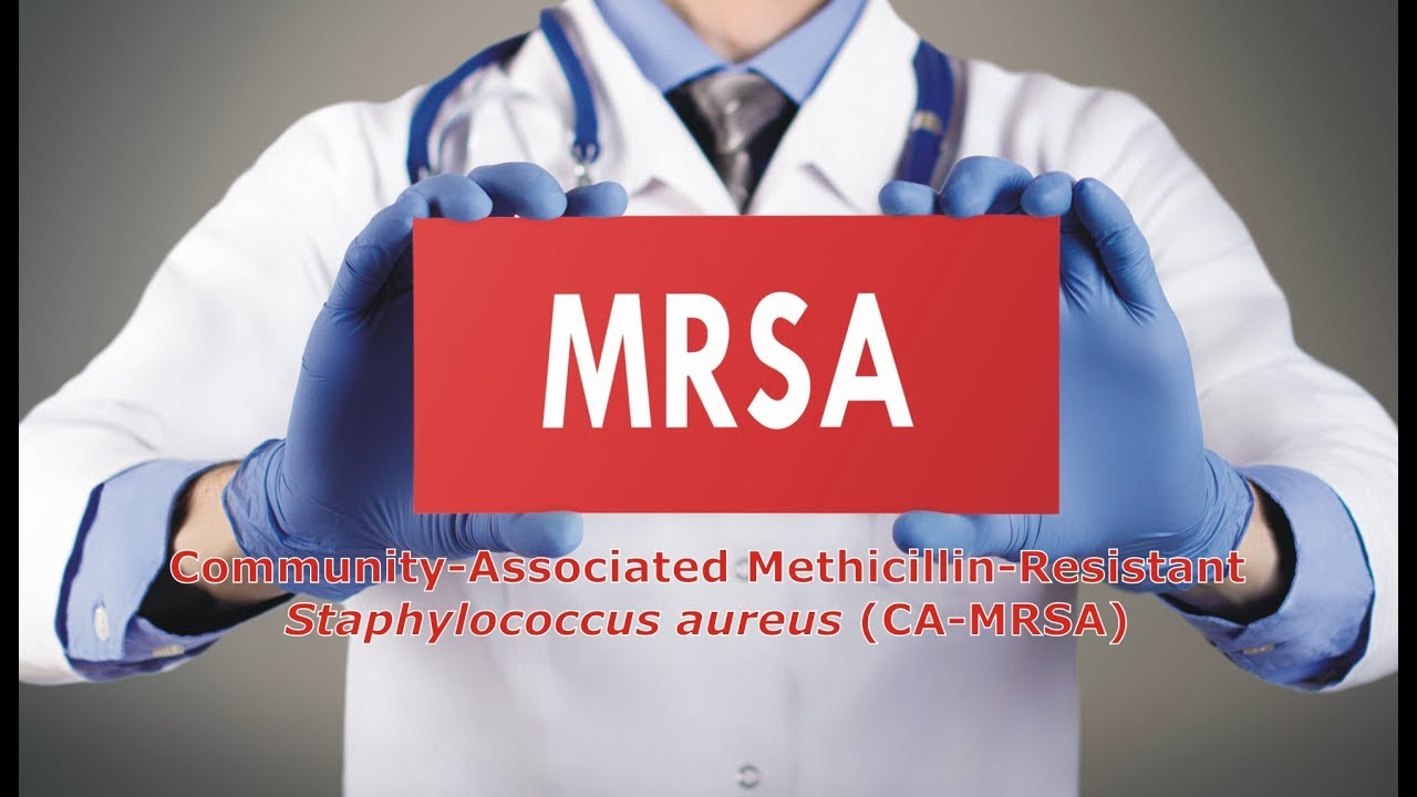 CA-MRSA: Community-Associated Methicillin-Resistant Staphylococcus aureus