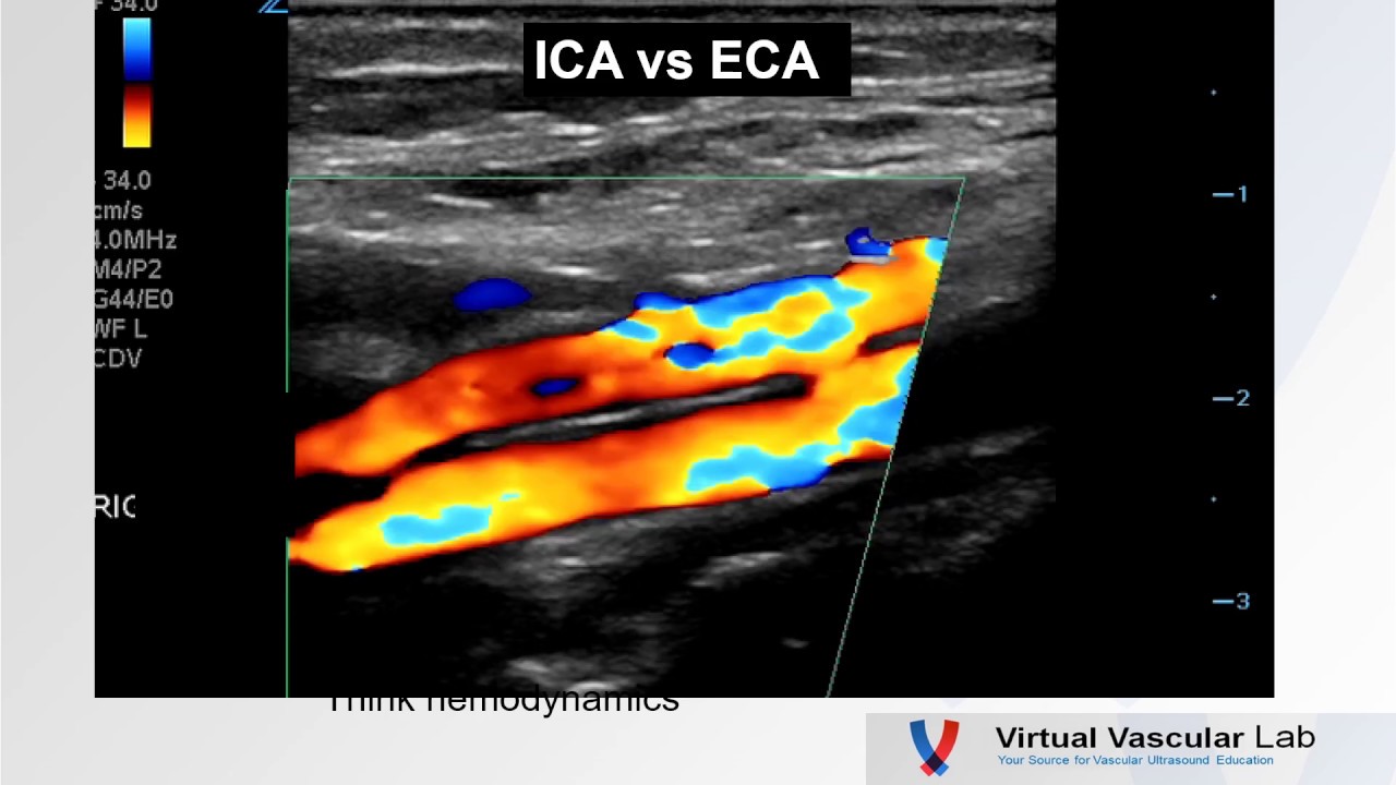 Carotid Duplex Quiz - Virtual Vascular Lab Channel