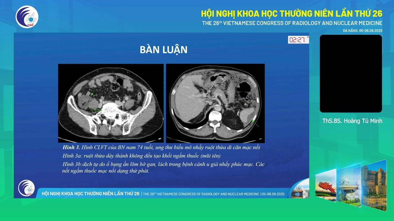 2. Đặc điểm hình ảnh u nhầy ruột thừa trên phim chụp CLVT (ThS.BS. Hoàng Tú Minh)