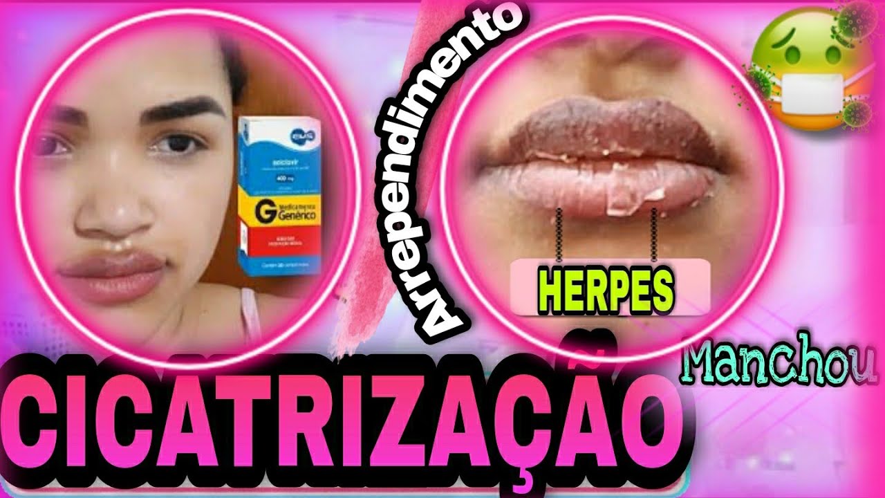 PARTE 2- Processo de CICATRIZAÇÃO-micro labial sem retoque