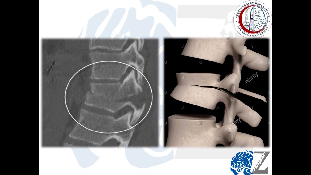 Spine Trauma(19):  Thoraco-Lumbar Spine Fractures(4): Seatbelt Fracture كسور الفقرات الصدرية-القطنية