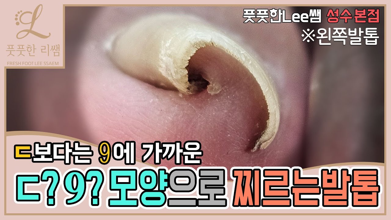 ㄷ자! 9 모양으로 찌르는 발톱! 어떻게 관리해야 할까요? ingrown toenail / ingrowing nail - Fresh Foot 풋풋한리쌤 성수본점