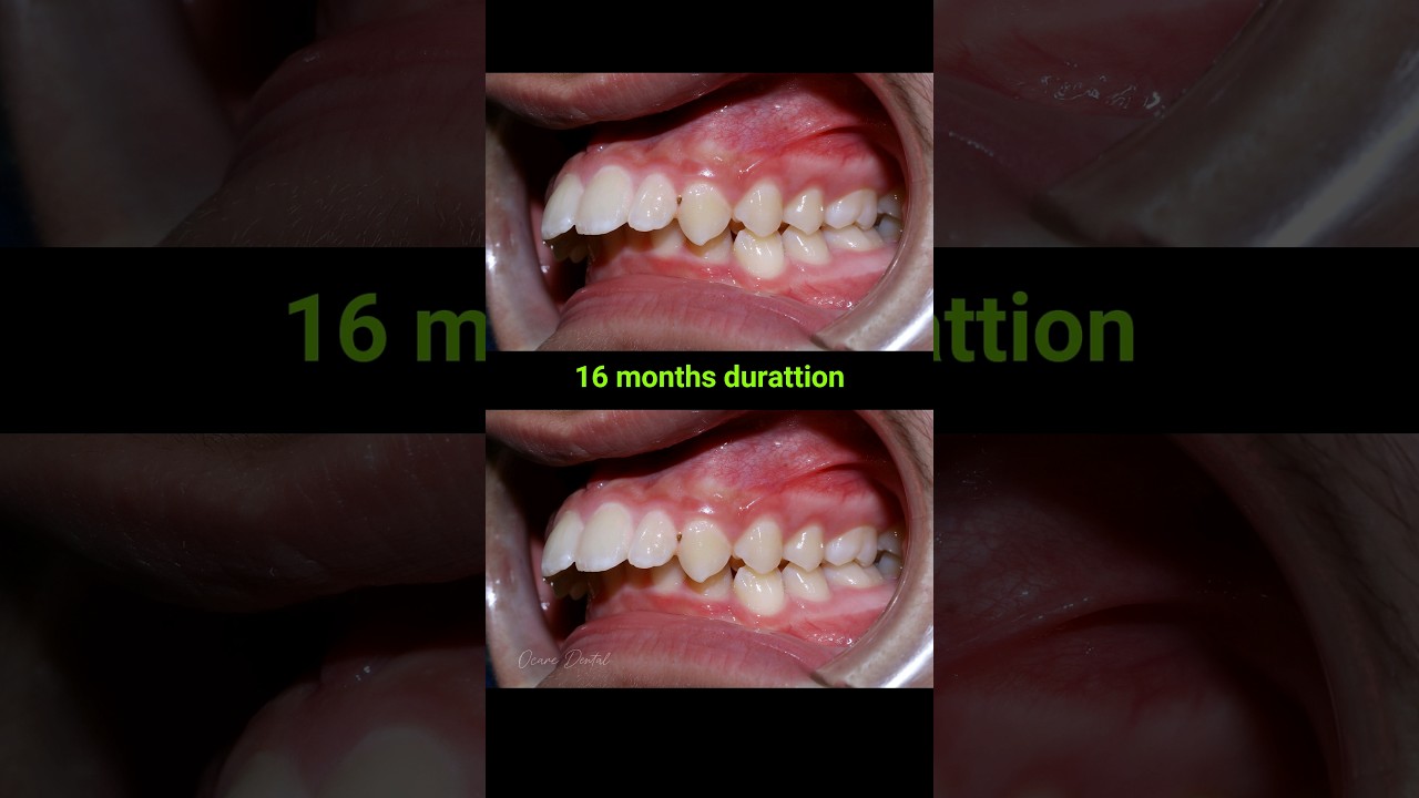 Braces for buck teeth, 16 months #braces #orthodontist #dentaltreatment #dentist