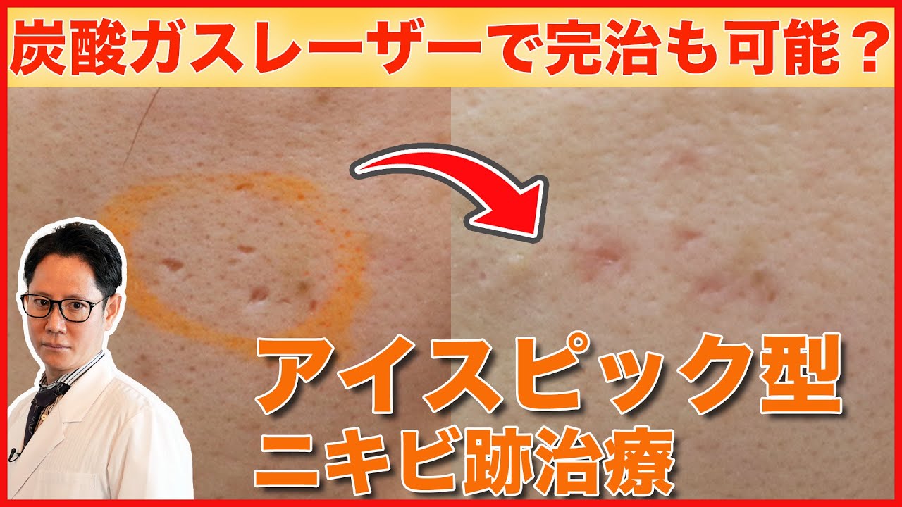 【ニキビ跡】アイスピック型のニキビ跡治療｜炭酸ガスレーザー(CO2レーザー)で完治可能？