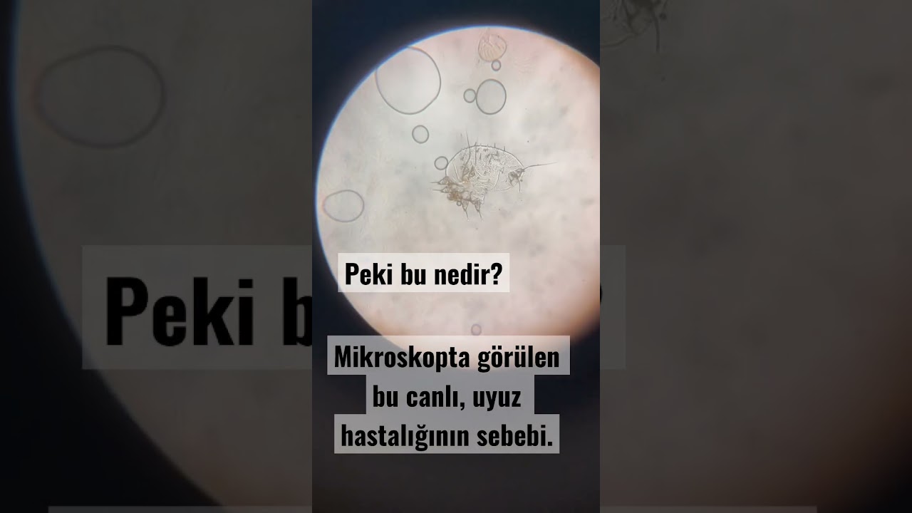 Uyuz hastalığı #dermatoloji #kaşıntı #ciltsağlığı