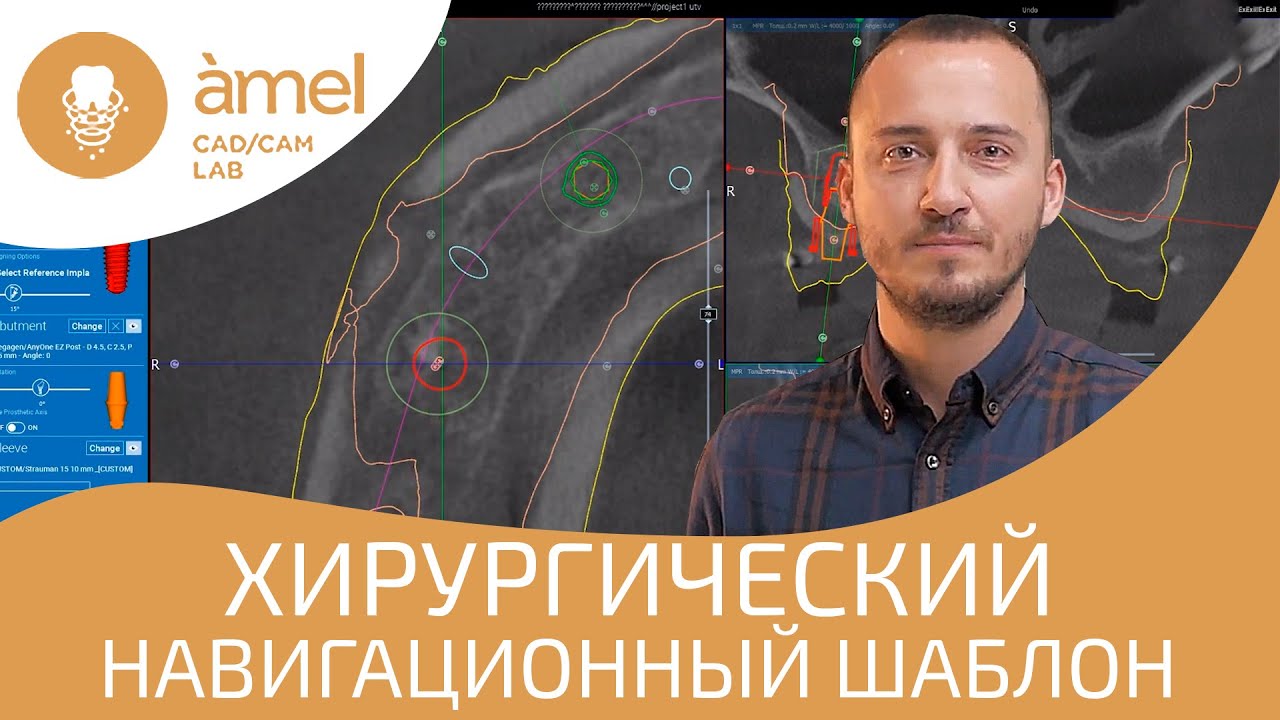 Хирургический навигационный шаблон в Bauers CAD/CAM Lab