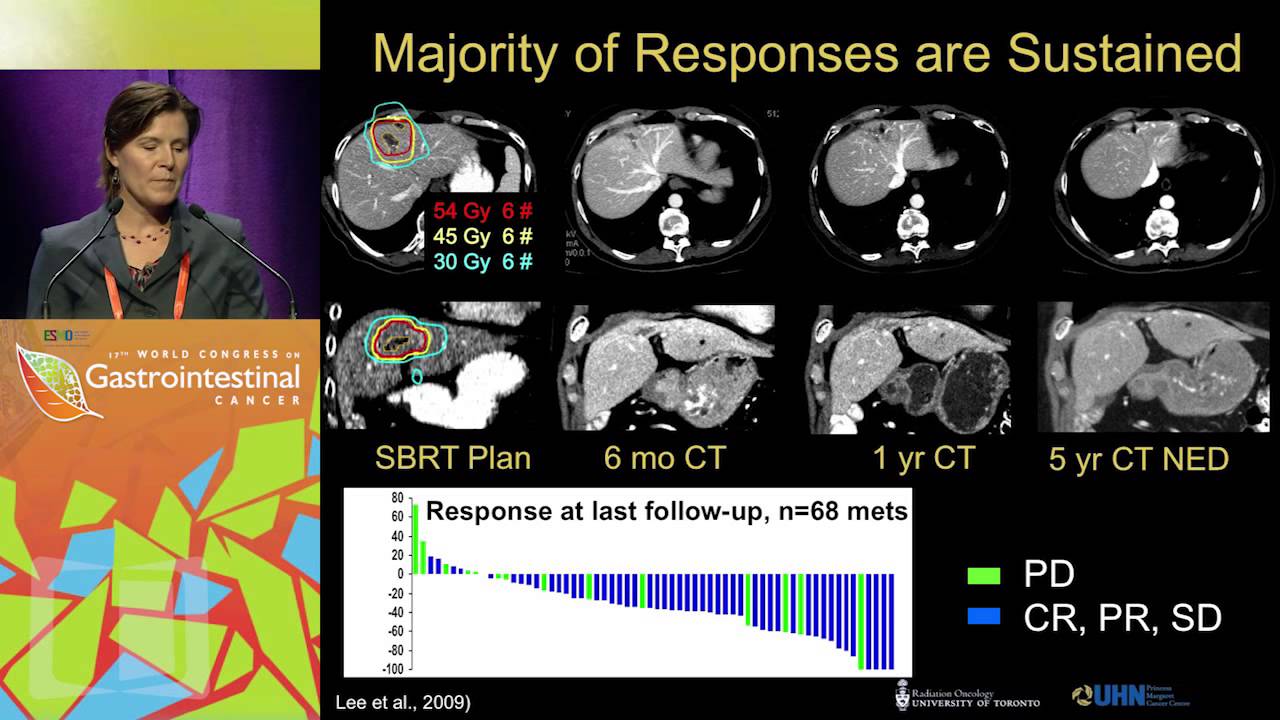 Liver directed therapy in incurable mCRC – Stereotactic radiotherapy