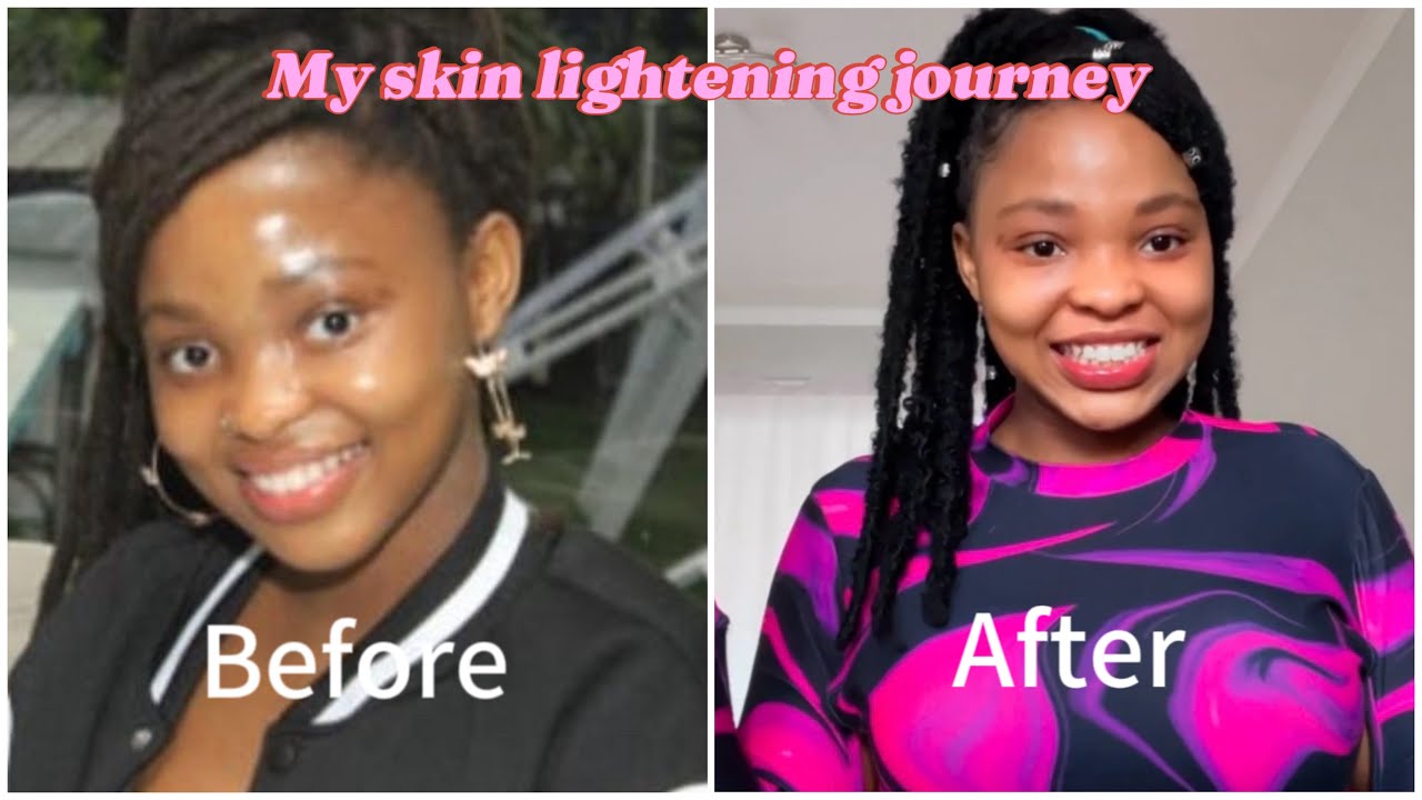 My skin lightening journey (how I lightened my skin with proof pictures) ||South African YouTuber