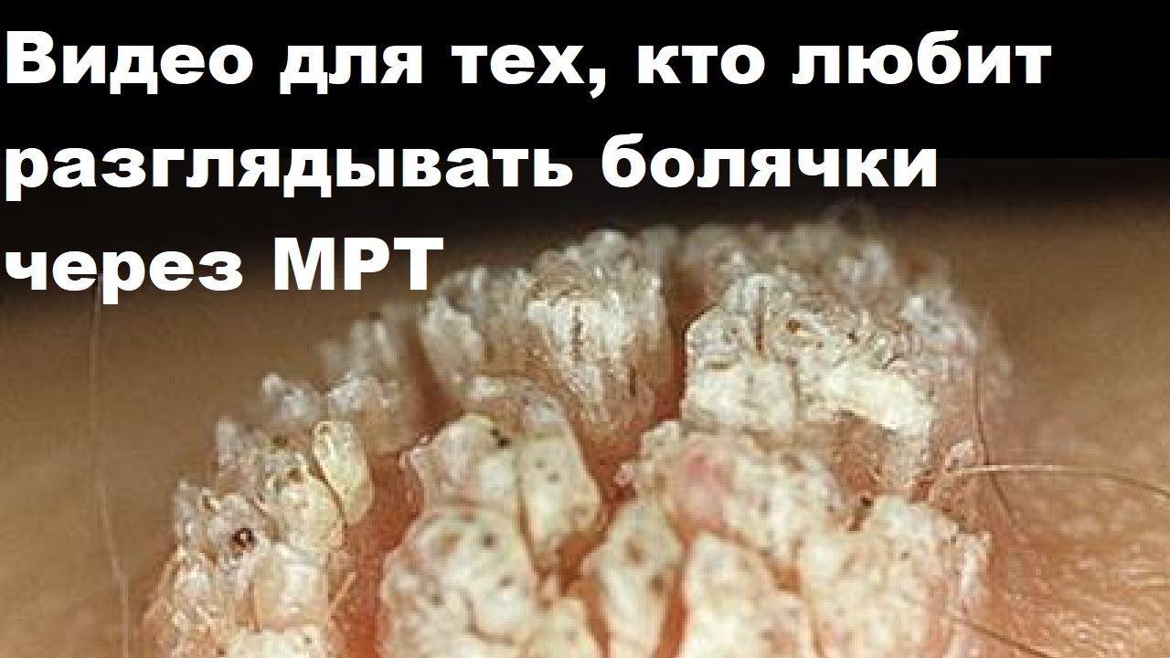 Видео для тех, кто любит разглядывать болячки через МРТ