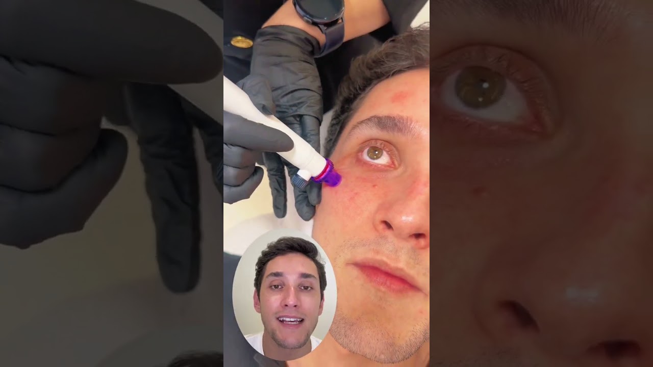 Purifica&ccedil;&atilde;o profunda da pele! #AquaPeel