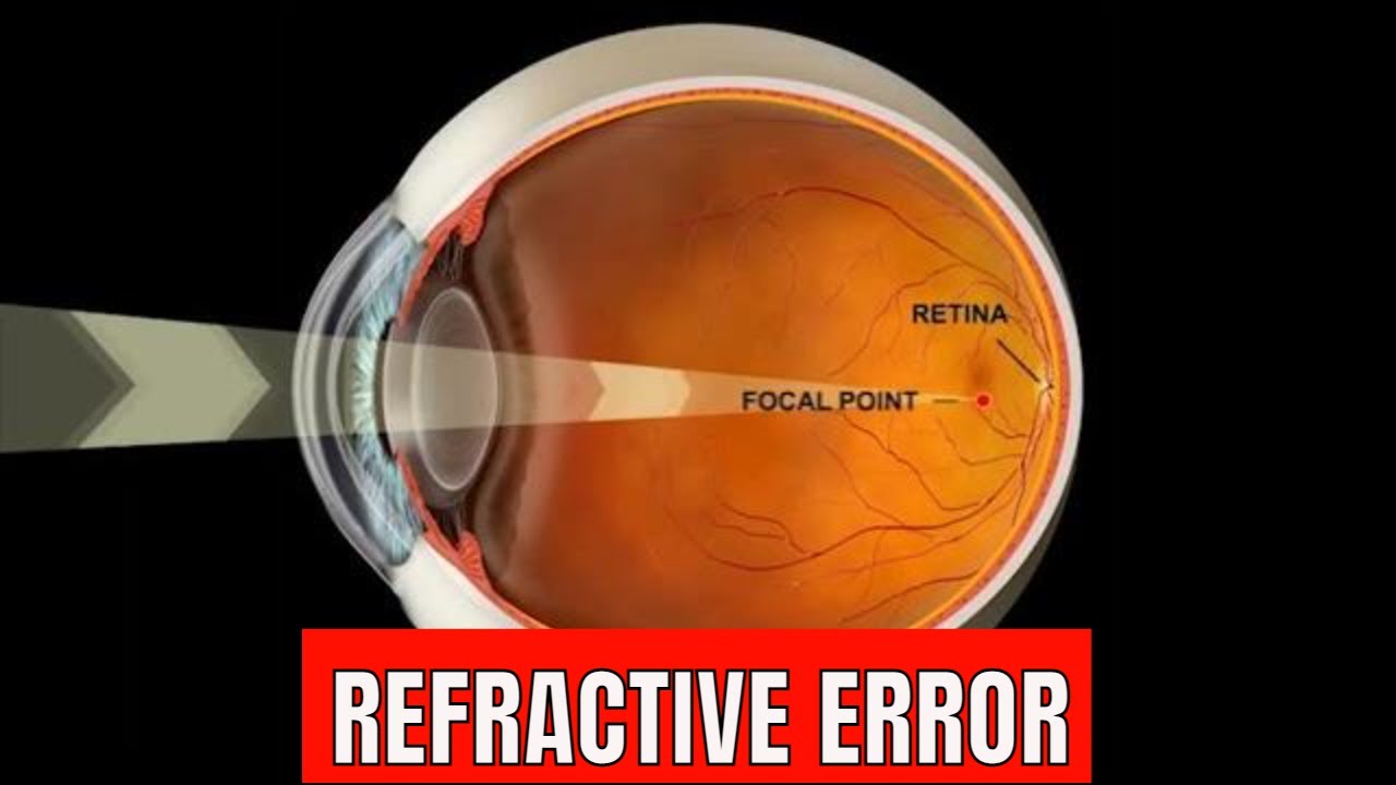Refractive error Of eye