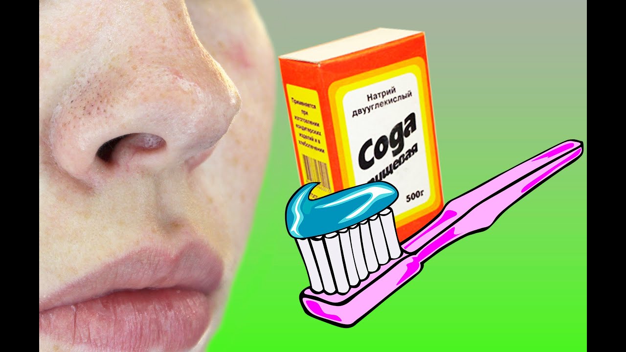 DIY: ЗУБНАЯ ПАСТА ОТ ЧЕРНЫХ ТОЧЕК. ПРАВДА ИЛИ ЛОЖЬ?