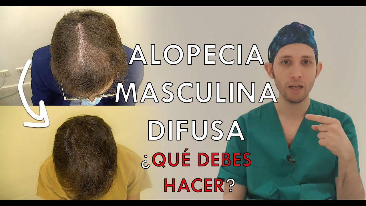 Alopecia masculina difusa ¿Qué DEBES HACER?