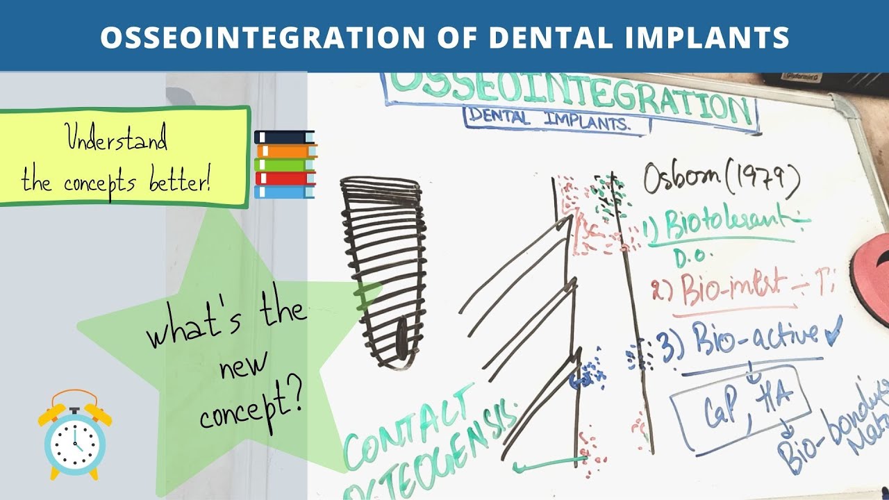 osseointegration of dental implants (Part - 2)